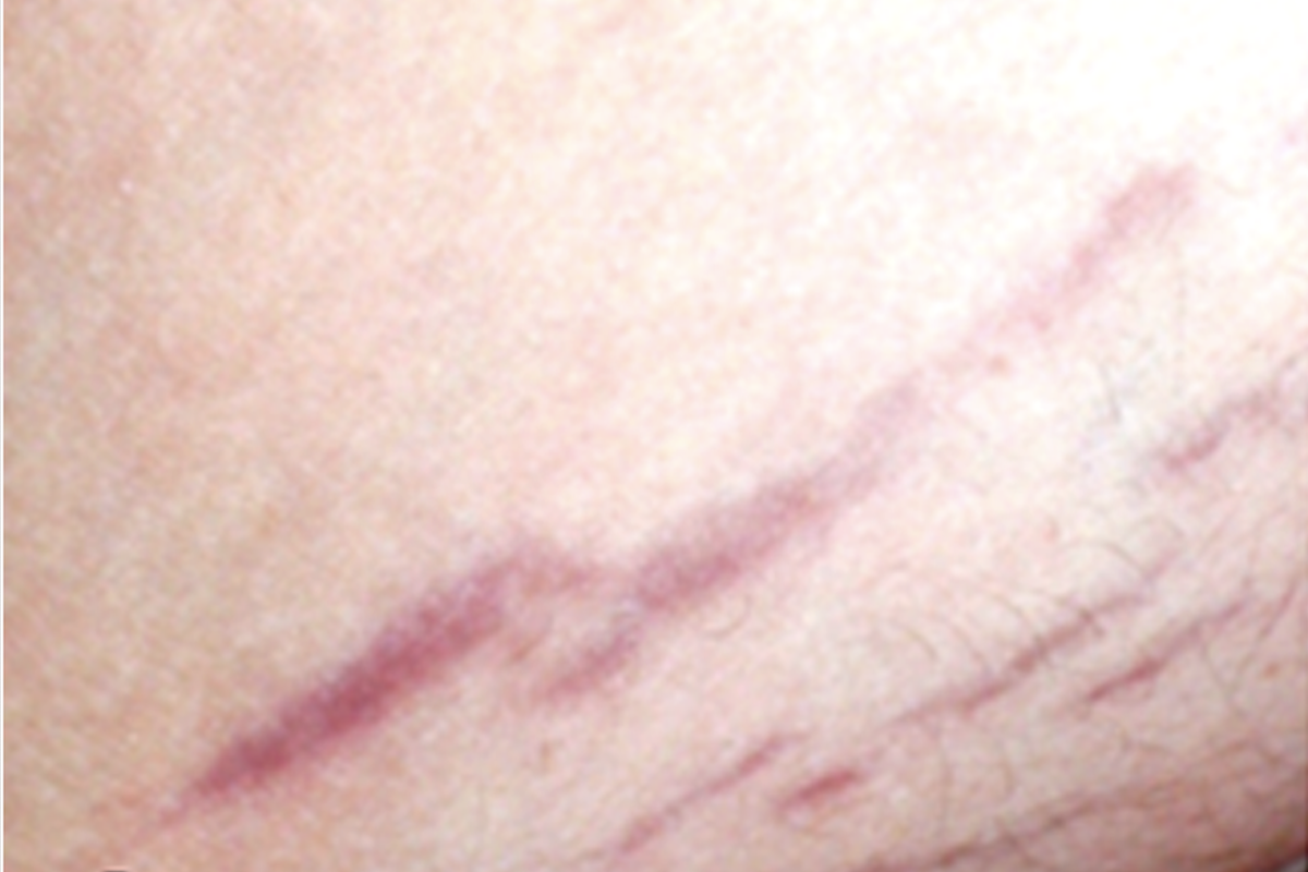 The characteristic skin rash, known as a bartonella rash, is often a critical clue to the presence of an underlying infection