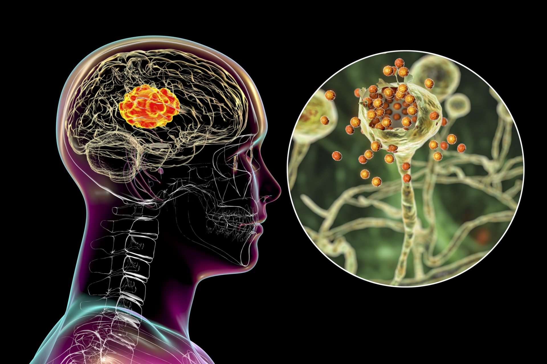 Mold toxicity in brain that causes mental health disorders
