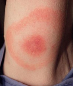 Bullseye rash - lyme disease 2