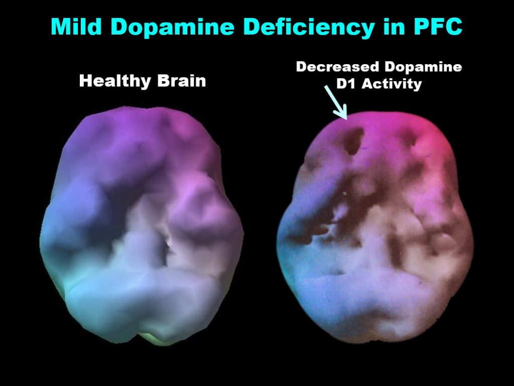 Brain pet scan of dopamine