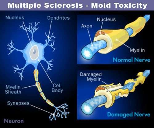 Multiple sclerosis - myelin- mold toxicity - sponaugle wellness institute