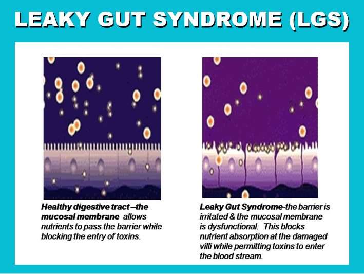 Antibiotic therapy and its role in the pathogenesis of leaky gut syndrome